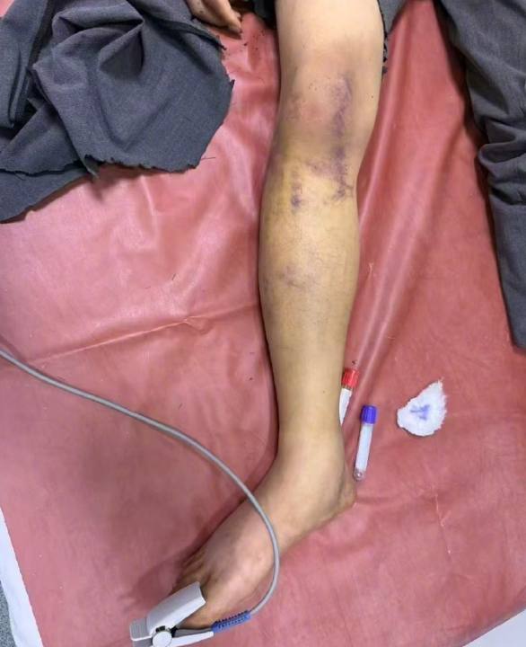 中国博主非洲拒做诈骗遭同胞虐打手脚尽断跳车逃命